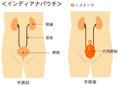 東海大学医学部外科学系腎泌尿器科学 膀胱腫瘍 尿路変更術について