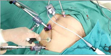 腹腔鏡手術の様子2