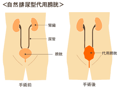 自然排尿型代用膀胱
